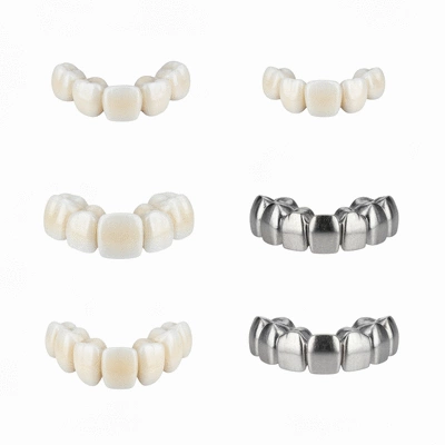 Close-up of different types of dental bridges made from various materials like porcelain, metal, and zirconia, neatly arranged on a clean white background